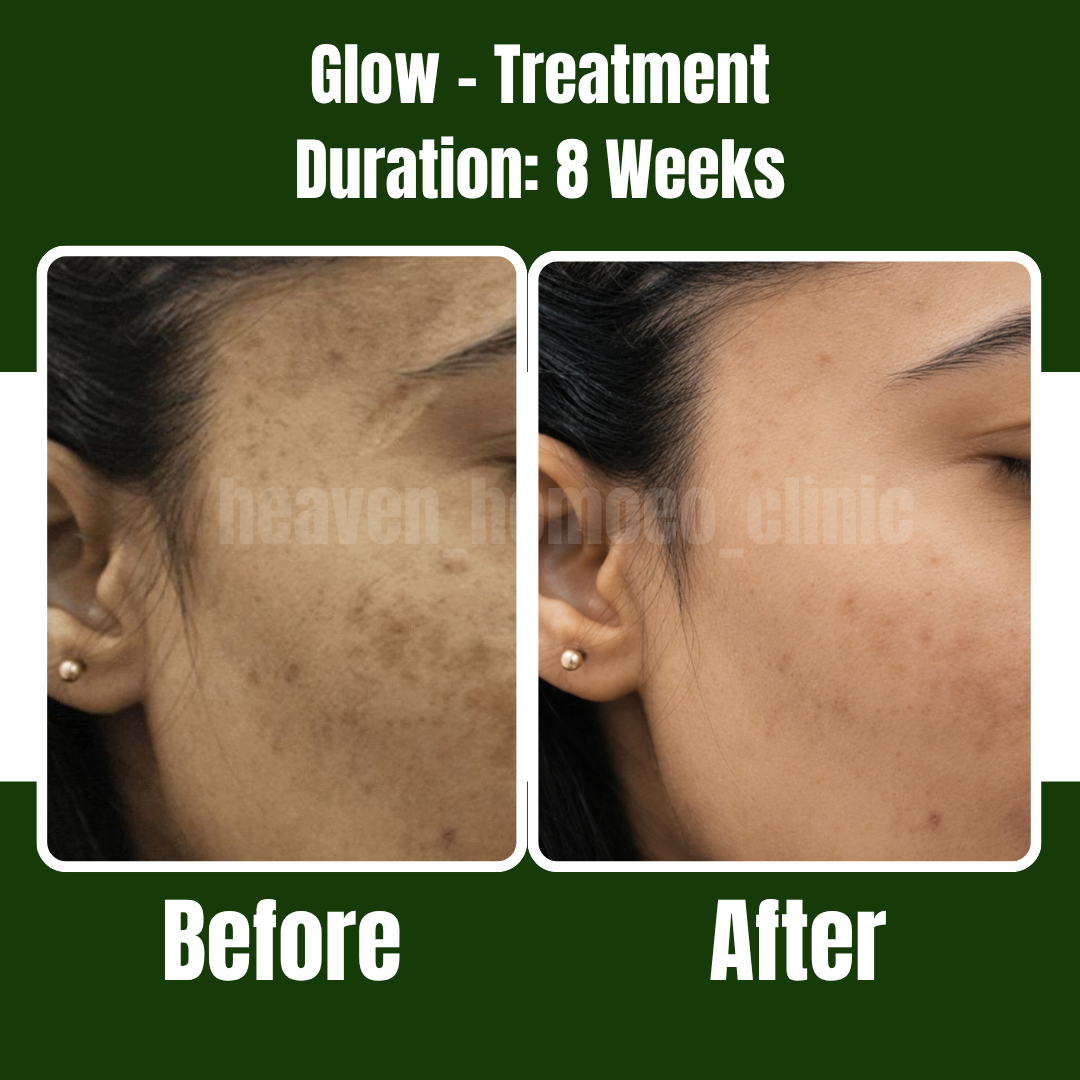 Glow Treatment patient result