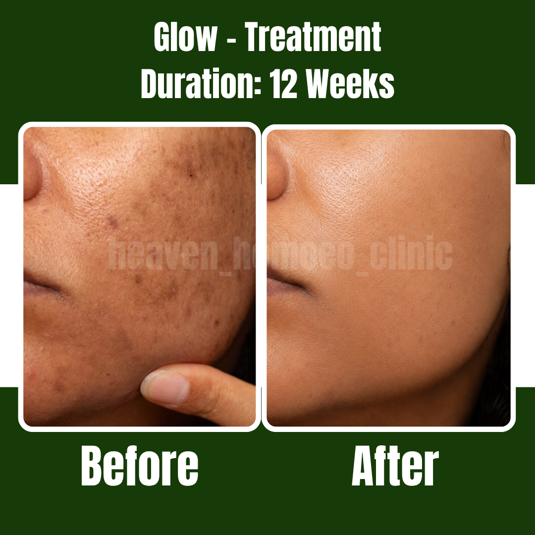 Glow Treatment patient result