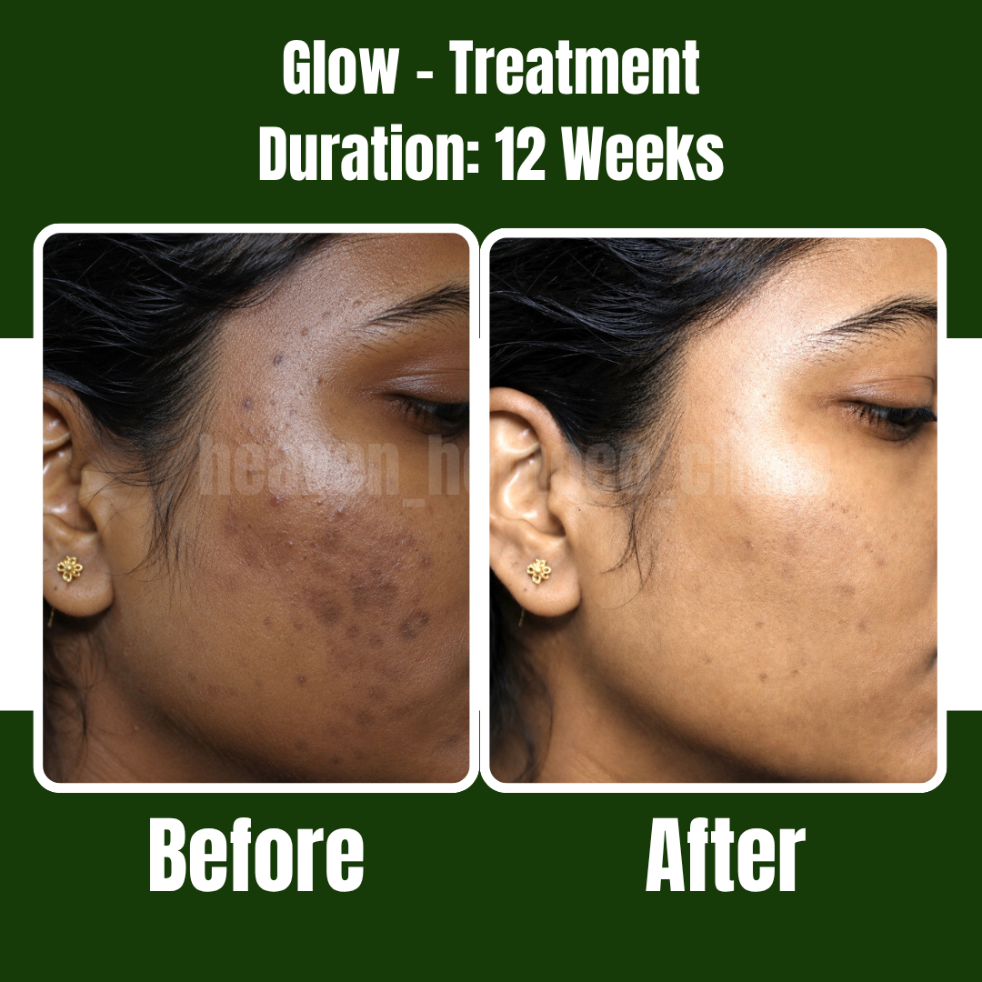 Glow Treatment patient result